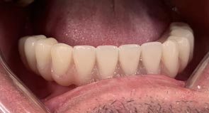Teeth in one day step 4