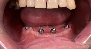 Teeth in one day step 1