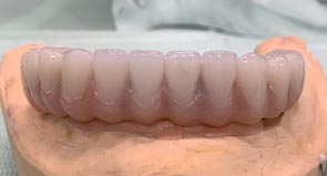 Teeth
																														 in one day step 2