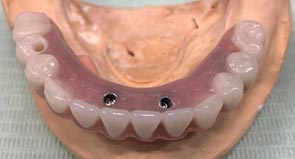 Teeth in one day step 3