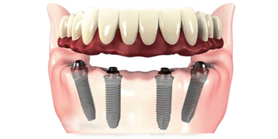 all-on-4-dental implants all-on-4-dental implants