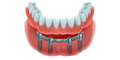 Bar retained over denture