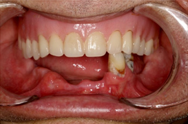 denture over implant clinical case#1