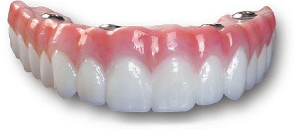 denture over implants