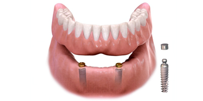 dental implant overdenture dental implant overdenture