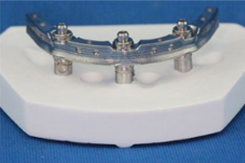denture over implant clinical case#5
