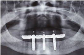 denture over implant clinical case#9