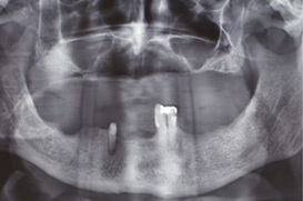 denture over implant clinical case#2