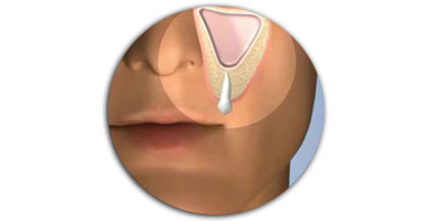 Sinus lift surgery